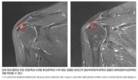 힘찬병원, 회전근개 부분 파열 '콜라겐 주입' 치료 효과 확인