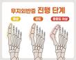 엄지발가락 휘면 걸음도 무너져… 무지외반증 방치 보행장애 악화
